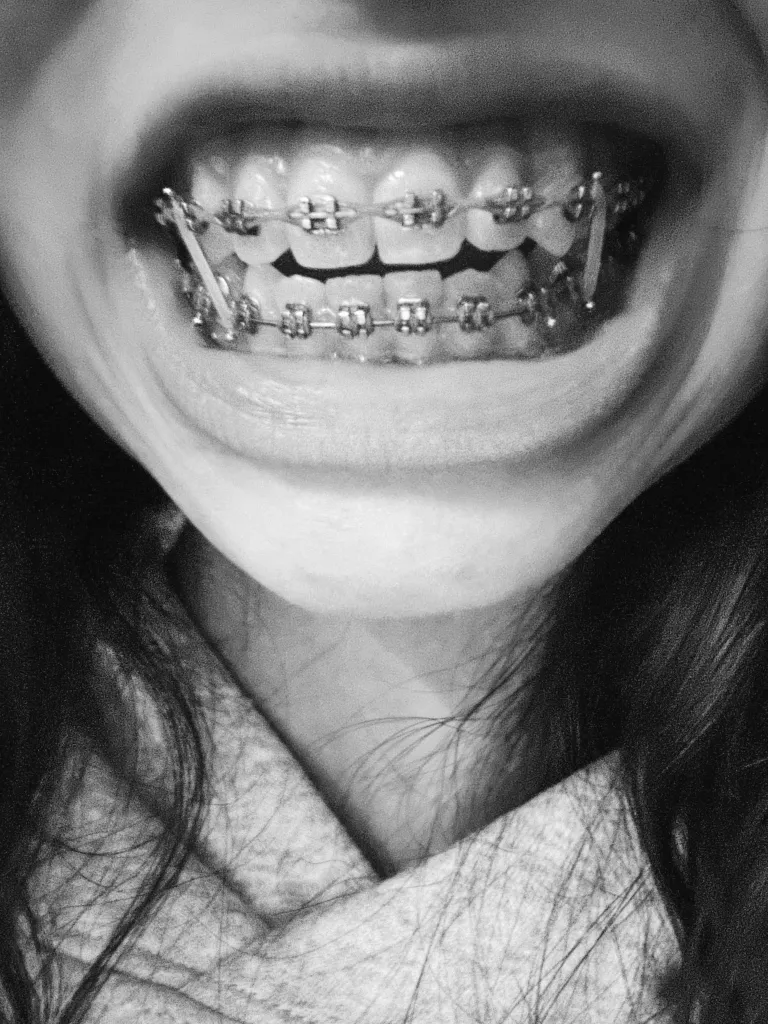 Close up of teeth with braces. 