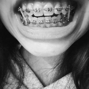 Close up of teeth with braces. 